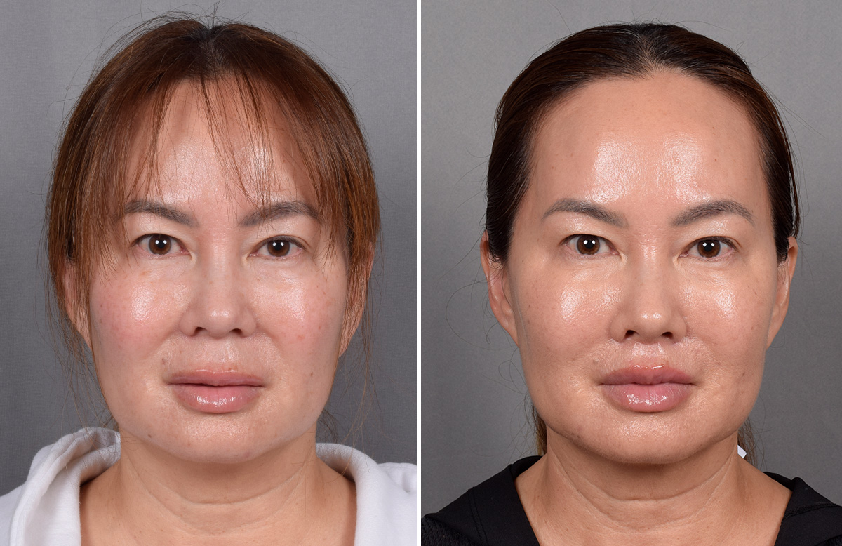 Lip Lift Before & After Gallery - Patient 310520 - Image 7
