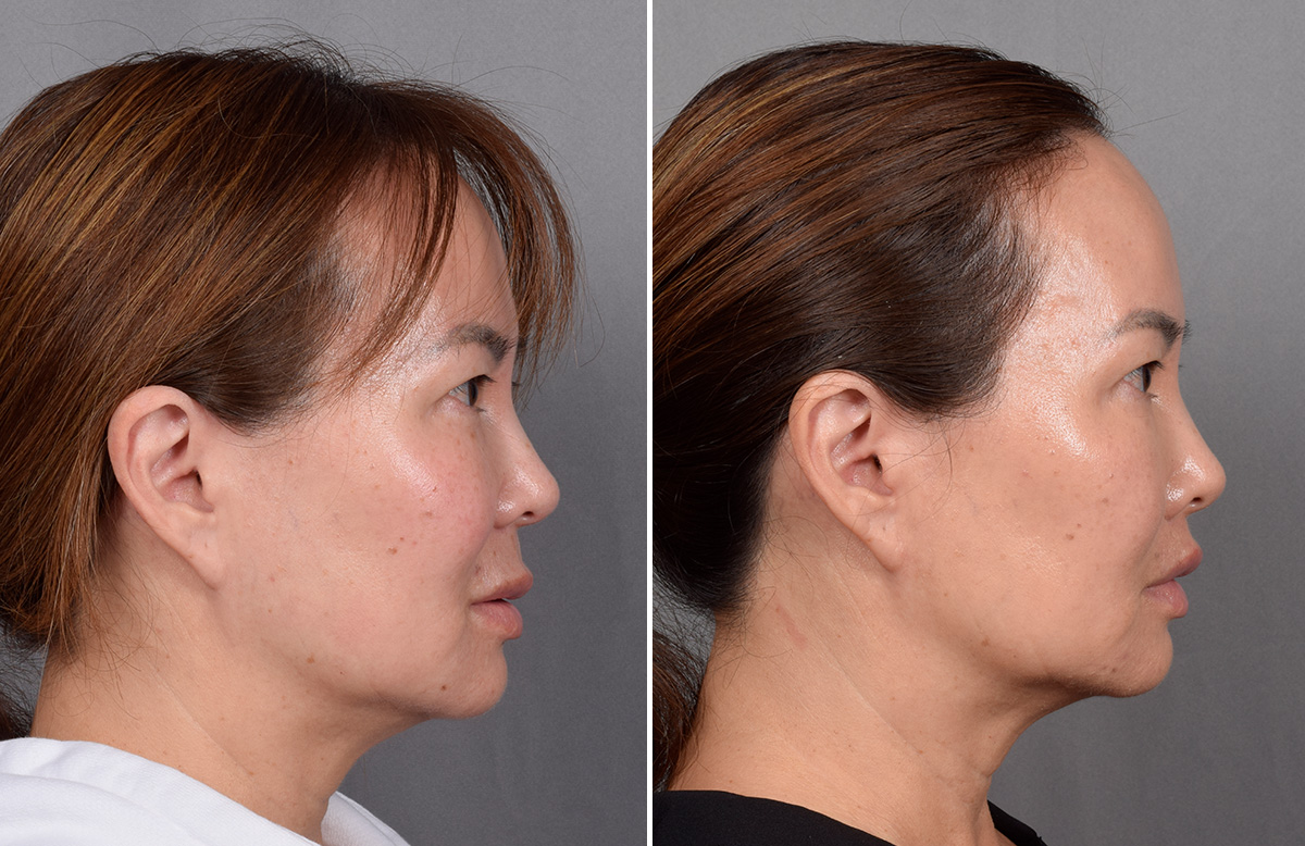 Lip Lift Before & After Gallery - Patient 310520 - Image 9