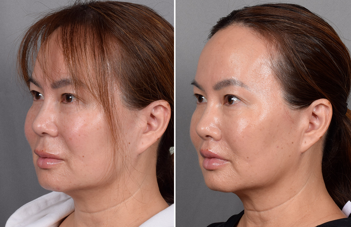Lip Lift Before & After Gallery - Patient 310520 - Image 10