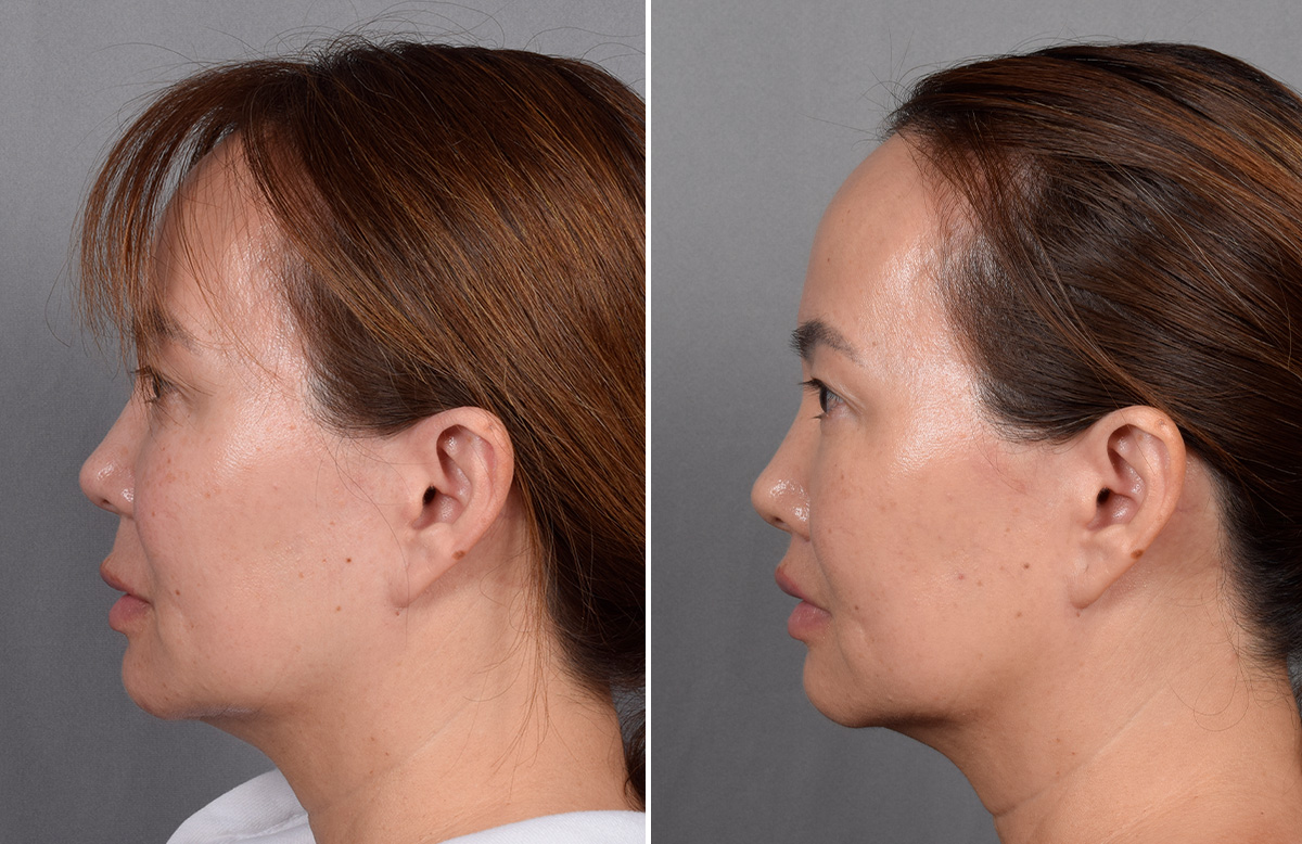 Lip Lift Before & After Gallery - Patient 310520 - Image 11