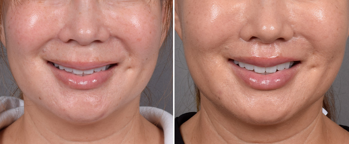 Lip Lift Before & After Gallery - Patient 310520 - Image 2