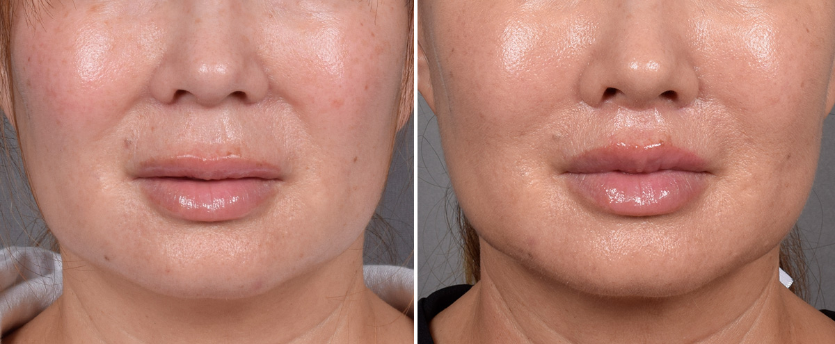 Lip Lift Before & After Gallery - Patient 310520 - Image 1