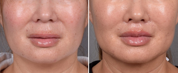 Lip Lift Before & After Gallery - Patient 310520 - Image 1