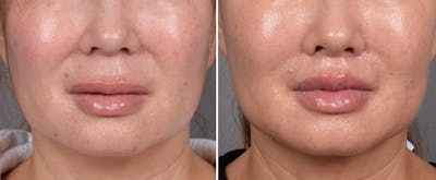 Lip Lift Before & After Gallery - Patient 310520 - Image 1
