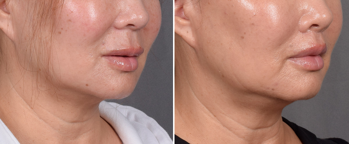 Lip Lift Before & After Gallery - Patient 310520 - Image 3