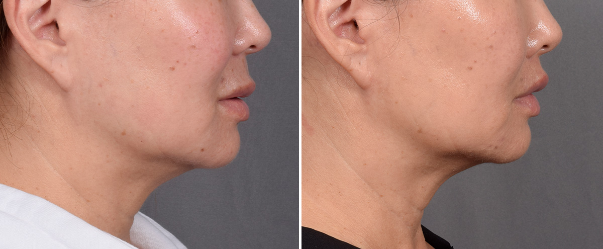 Lip Lift Before & After Gallery - Patient 310520 - Image 4