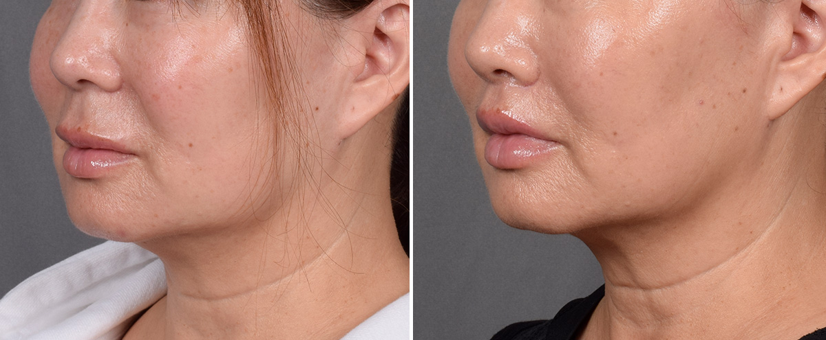 Lip Lift Before & After Gallery - Patient 310520 - Image 5