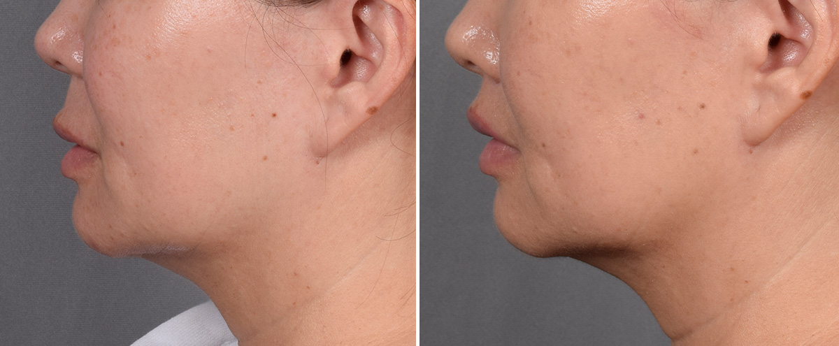 Lip Lift Before & After Gallery - Patient 310520 - Image 6