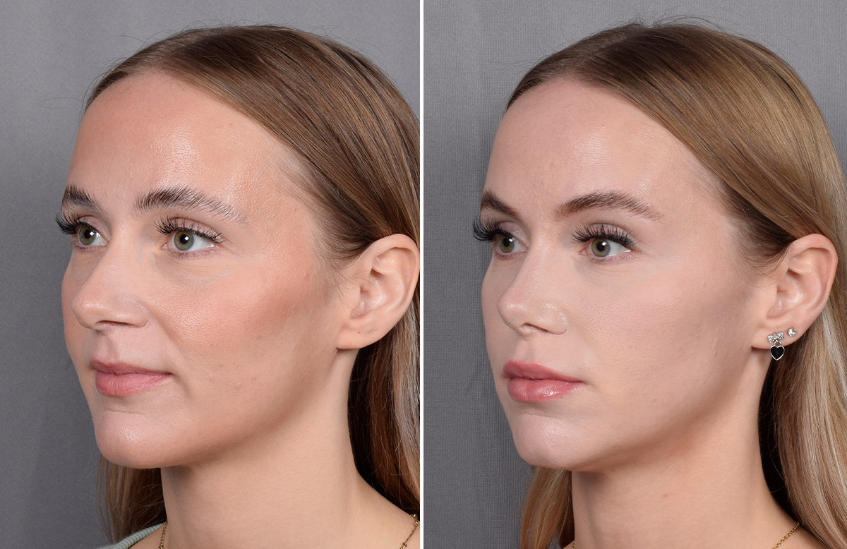 Lip Lift Before & After Gallery - Patient 282228 - Image 11