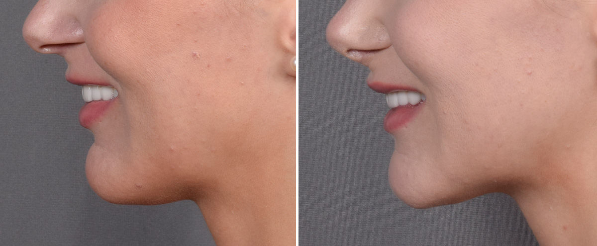 Lip Lift Before & After Gallery - Patient 282228 - Image 6