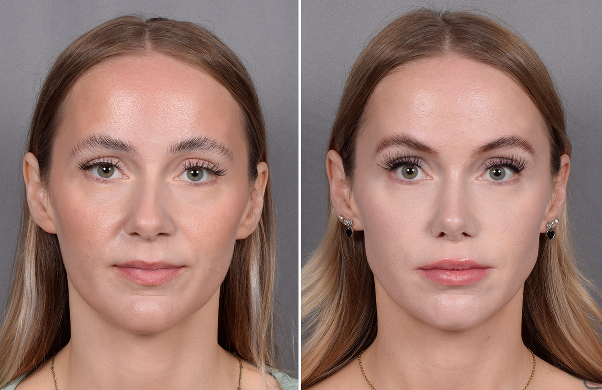 Lip Lift Before & After Gallery - Patient 282228 - Image 7