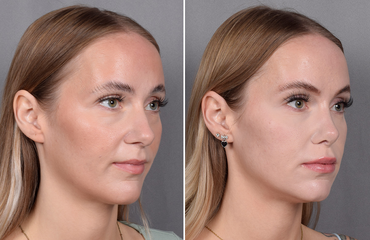 Lip Lift Before & After Gallery - Patient 282228 - Image 8