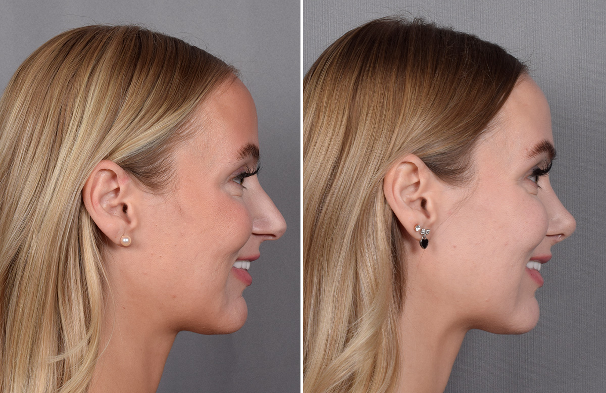 Lip Lift Before & After Gallery - Patient 282228 - Image 10