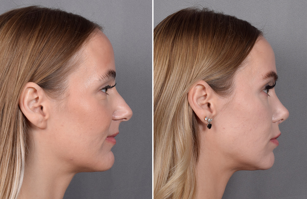 Lip Lift Before & After Gallery - Patient 282228 - Image 9