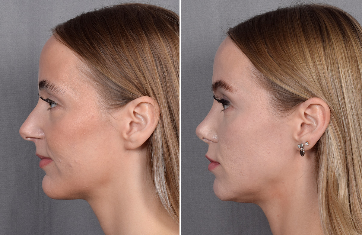Lip Lift Before & After Gallery - Patient 282228 - Image 12