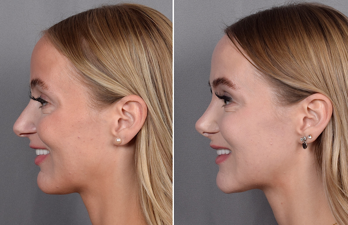 Lip Lift Before & After Gallery - Patient 282228 - Image 13