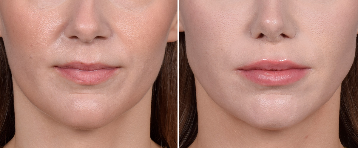 Lip Lift Before & After Gallery - Patient 282228 - Image 1