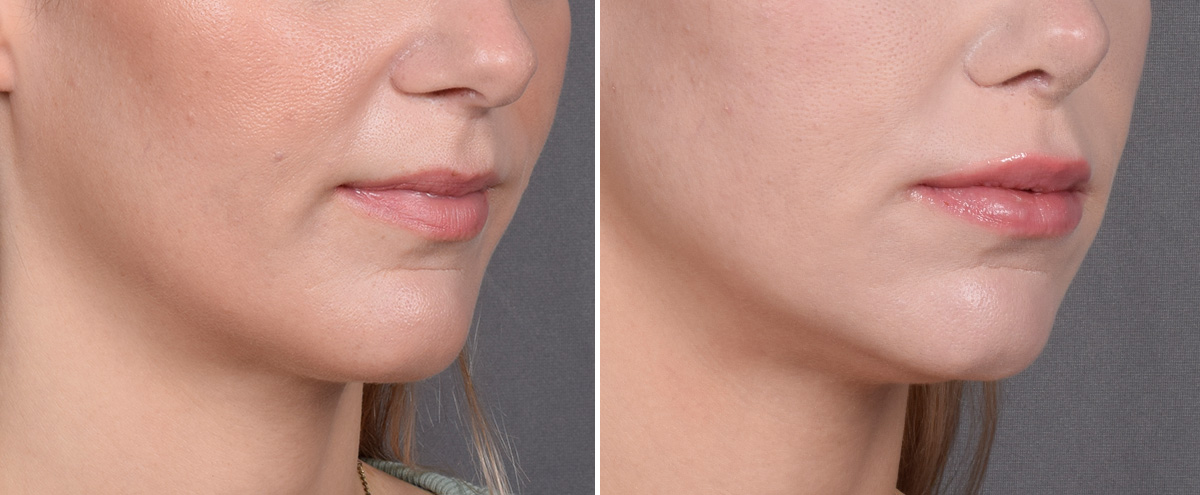 Lip Lift Before & After Gallery - Patient 282228 - Image 2
