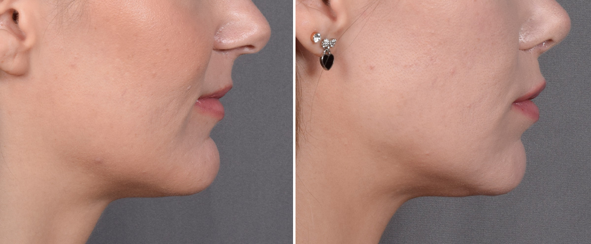 Lip Lift Before & After Gallery - Patient 282228 - Image 3
