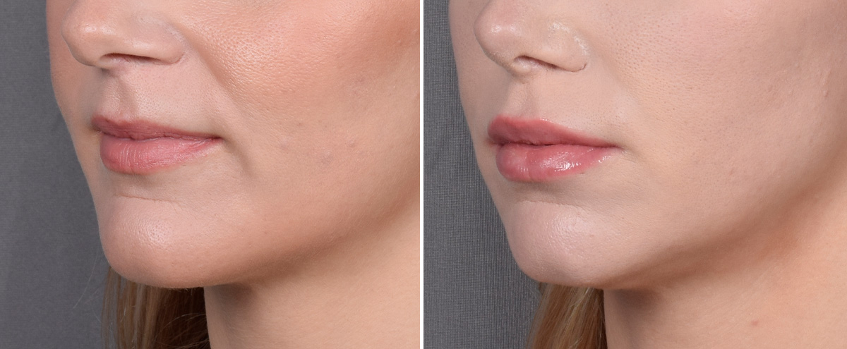 Lip Lift Before & After Gallery - Patient 282228 - Image 4