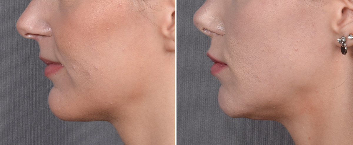 Lip Lift Before & After Gallery - Patient 282228 - Image 5