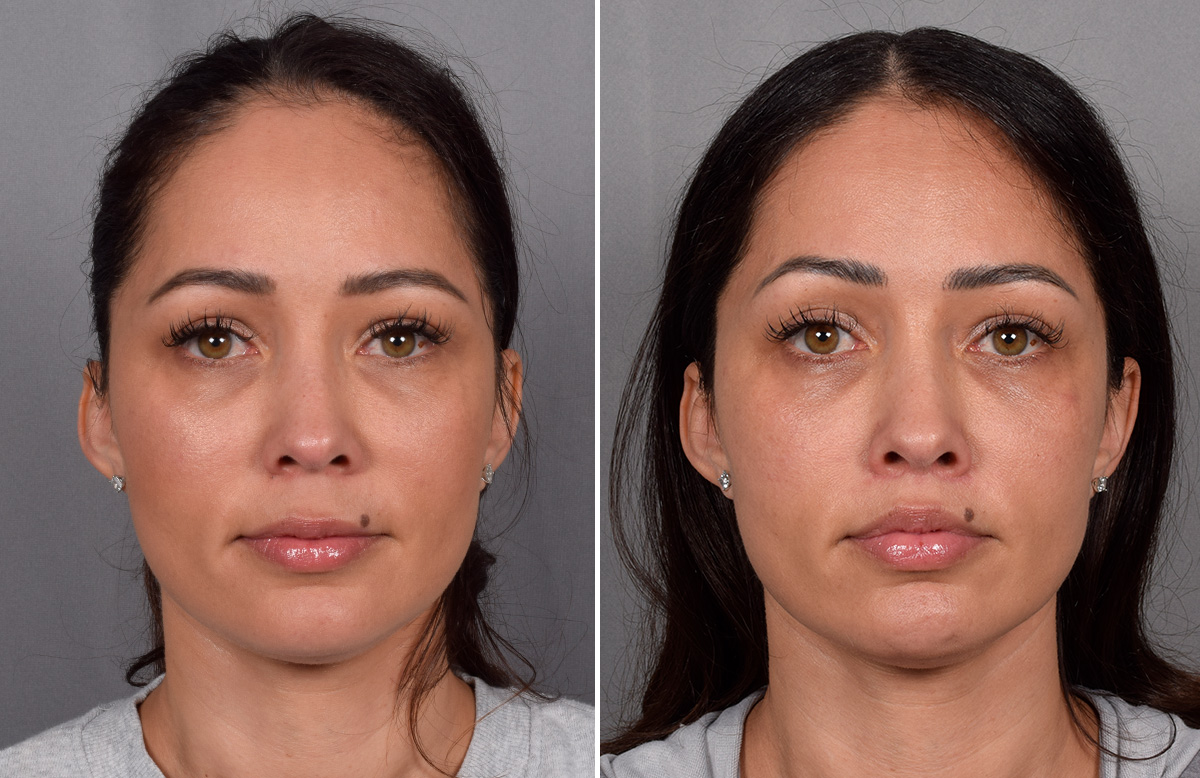CO2 Laser Before & After Gallery - Patient 165841 - Image 3