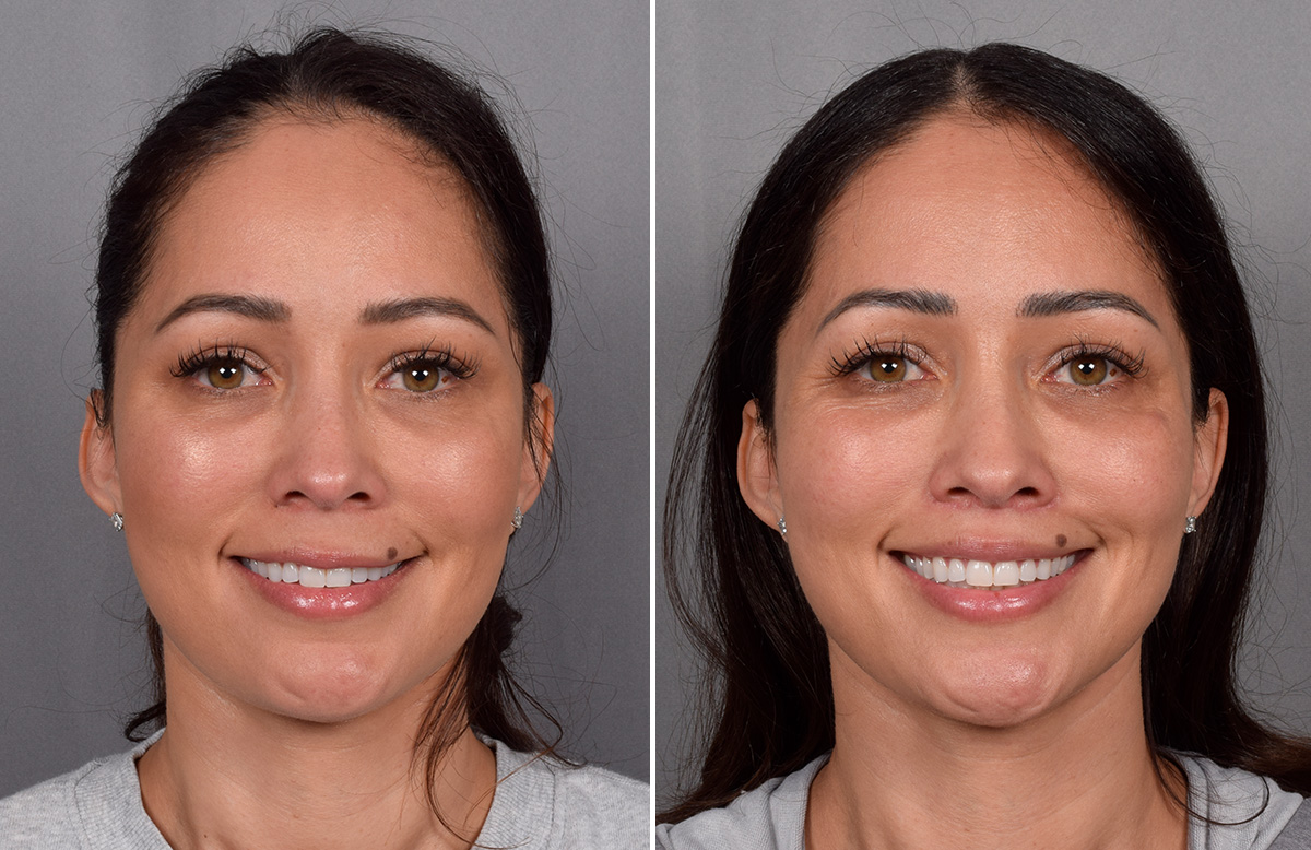CO2 Laser Before & After Gallery - Patient 165841 - Image 4