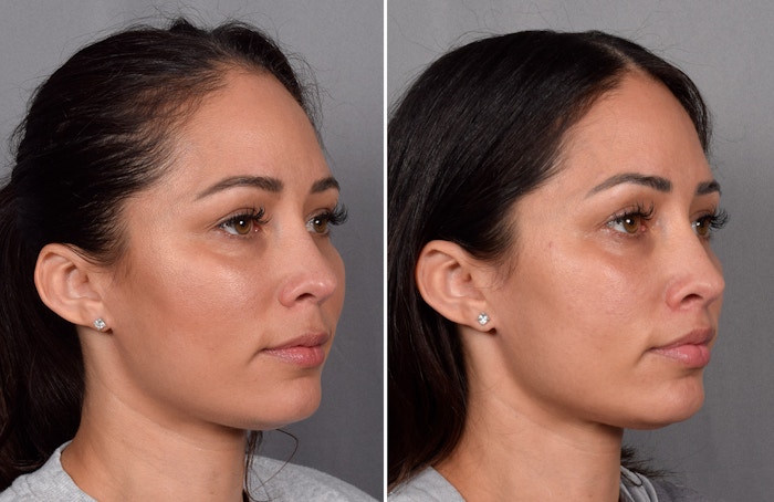 CO2 Laser Before & After Gallery - Patient 165841 - Image 1