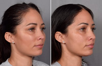 CO2 Laser Before & After Gallery - Patient 165841 - Image 1