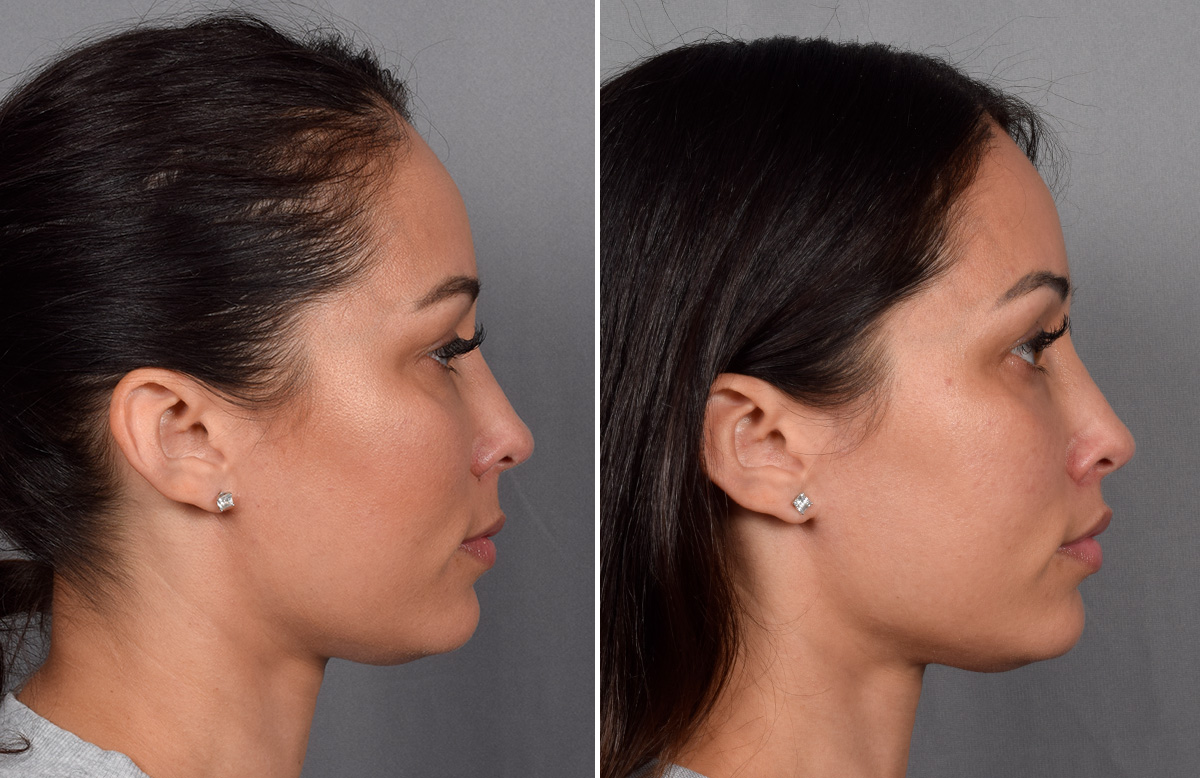 CO2 Laser Before & After Gallery - Patient 165841 - Image 2