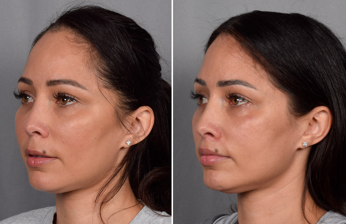 CO2 Laser Before & After Gallery - Patient 165841 - Image 6