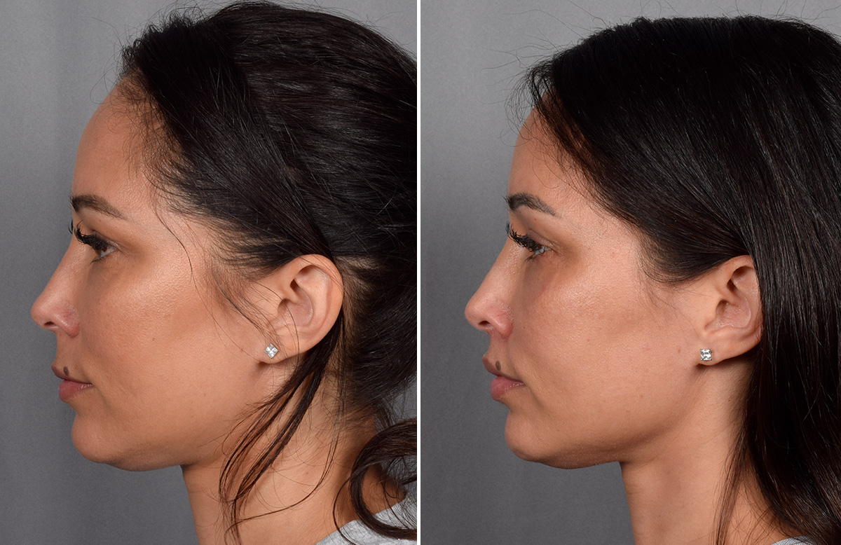 CO2 Laser Before & After Gallery - Patient 165841 - Image 5