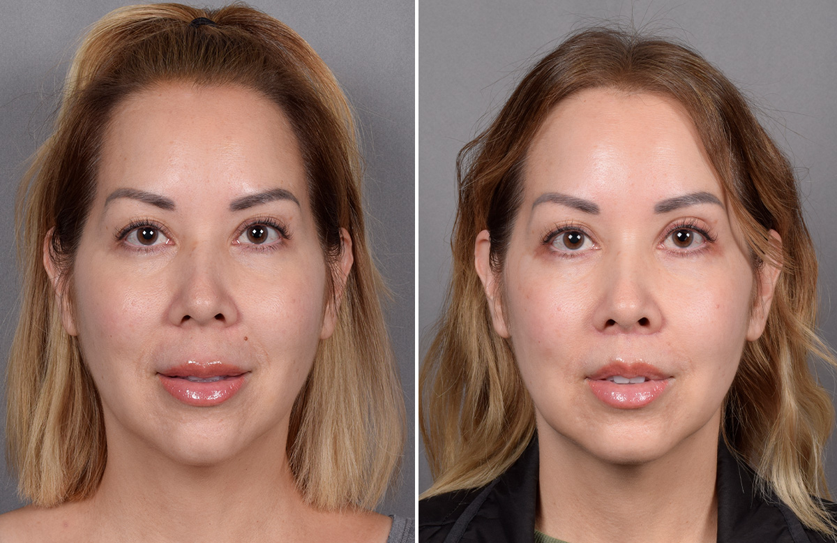 Lip Lift Before & After Gallery - Patient 252887 - Image 9