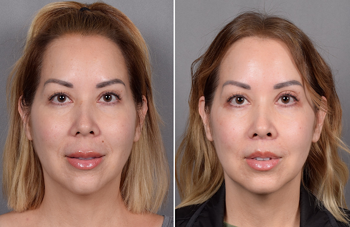 Lip Lift Before & After Gallery - Patient 252887 - Image 9