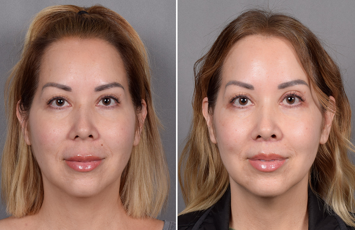 Lip Lift Before & After Gallery - Patient 252887 - Image 8
