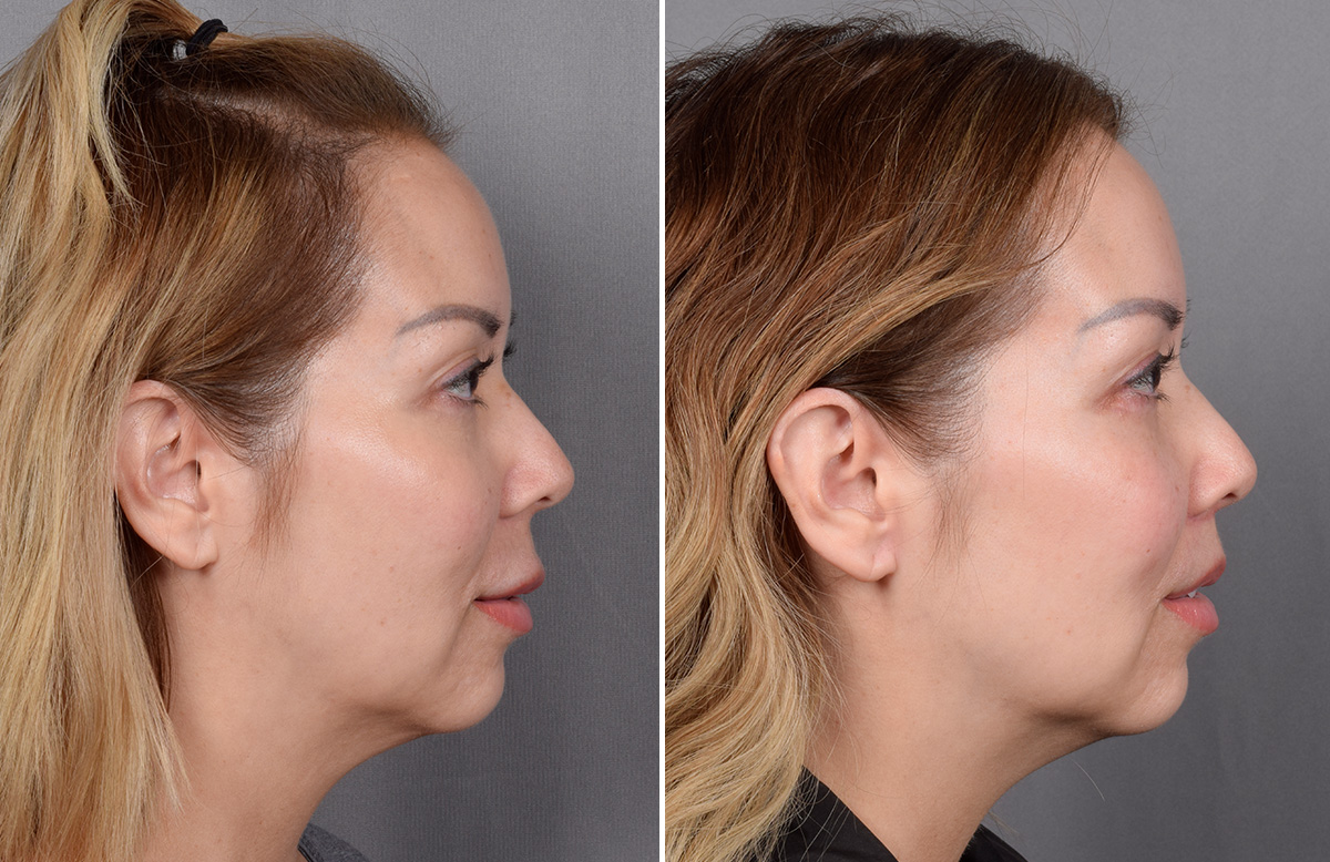 Lip Lift Before & After Gallery - Patient 252887 - Image 12