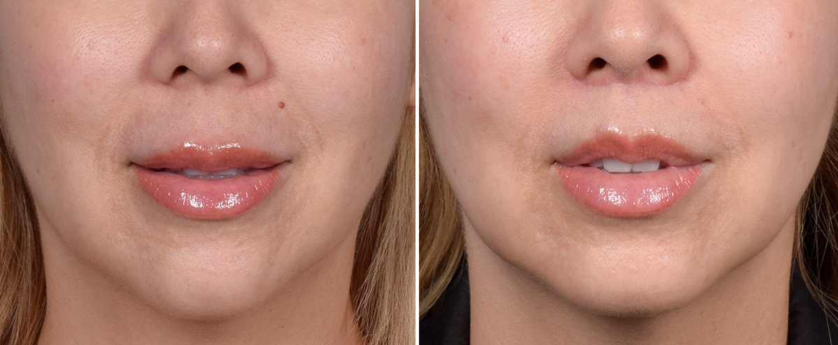 Lip Lift Before & After Gallery - Patient 252887 - Image 2