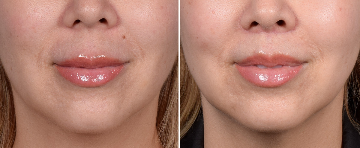 Lip Lift Before & After Gallery - Patient 252887 - Image 1
