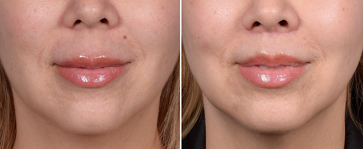 Lip Lift Before & After Gallery - Patient 252887 - Image 1