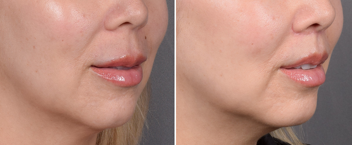 Lip Lift Before & After Gallery - Patient 252887 - Image 4