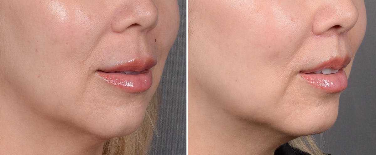 Lip Lift Before & After Gallery - Patient 252887 - Image 4