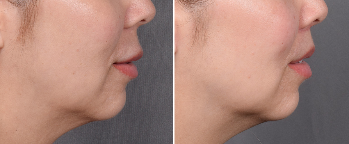 Lip Lift Before & After Gallery - Patient 252887 - Image 5