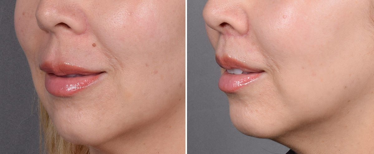 Lip Lift Before & After Gallery - Patient 252887 - Image 6