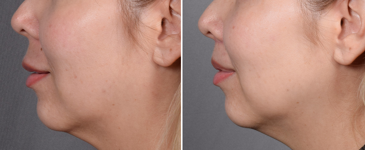 Lip Lift Before & After Gallery - Patient 252887 - Image 7