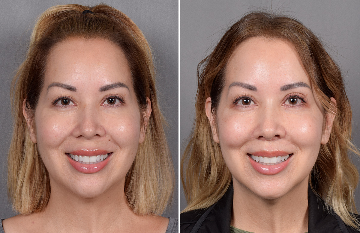 Lip Lift Before & After Gallery - Patient 252887 - Image 10