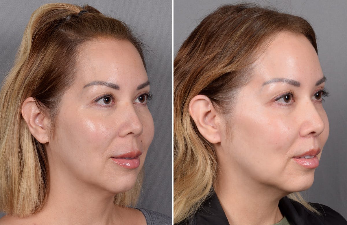 Lip Lift Before & After Gallery - Patient 252887 - Image 11