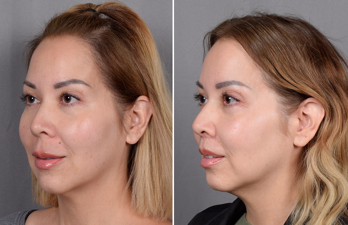 Lip Lift Before & After Gallery - Patient 252887 - Image 13