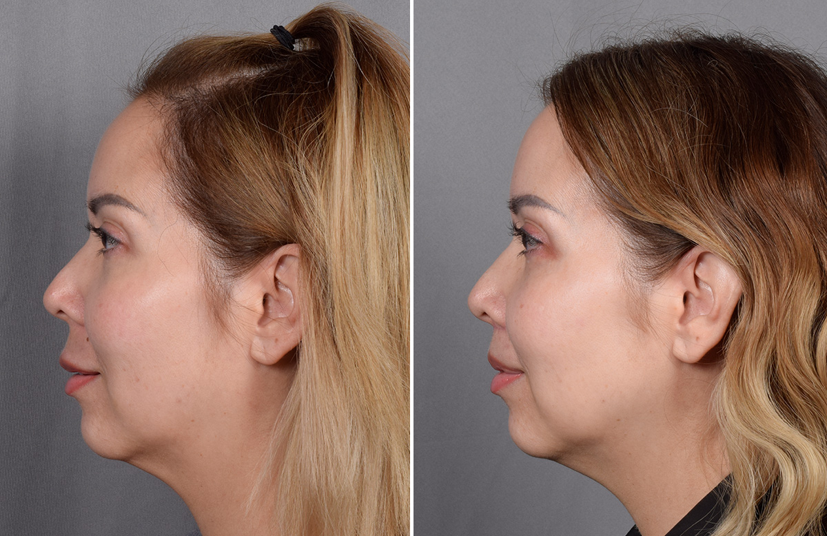 Lip Lift Before & After Gallery - Patient 252887 - Image 14