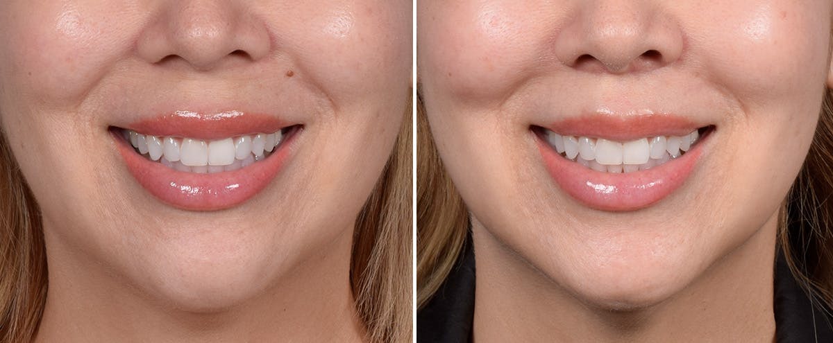 Lip Lift Before & After Gallery - Patient 252887 - Image 3