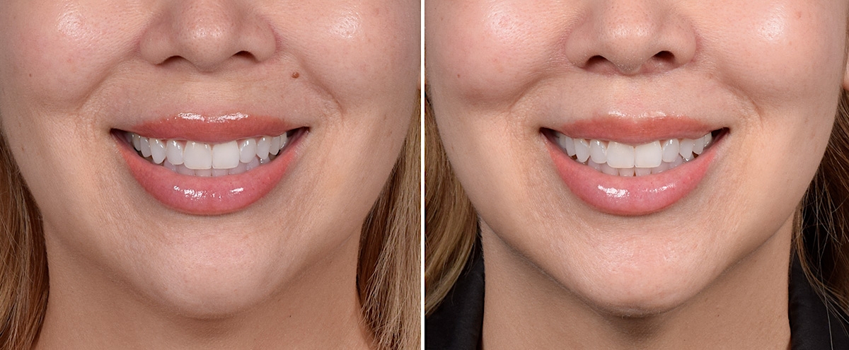 Lip Lift Before & After Gallery - Patient 252887 - Image 3